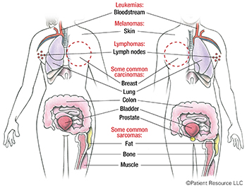 Understanding How Cancer Develops