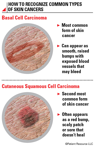 skin cancer cells vs normal cells