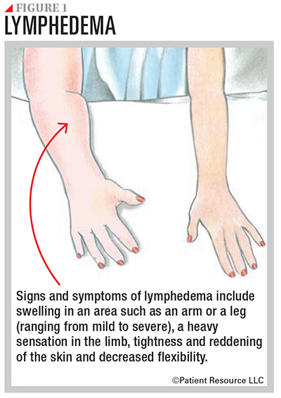 Lymphedema Causes, Symptoms & Treatment: Compression Garments