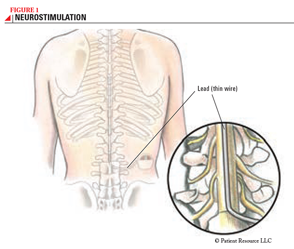 Spinal Cord Stimulation and Neurostimulation in Kansas City