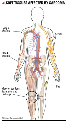 Soft Tissue Sarcoma