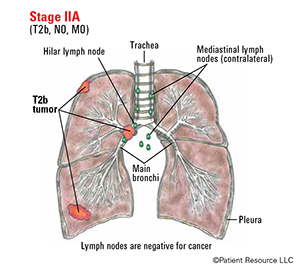 Lung Cancer Staging Illustrations