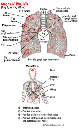 Lung Cancer Staging Illustrations