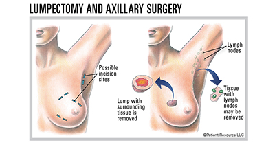 Breast-Conserving Surgery (Lumpectomy)